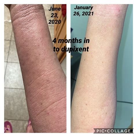 Dupixent result : r/eczema