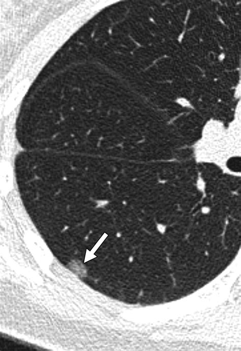 Ground-Glass Nodules on Chest CT as Imaging Biomarkers in the Management of Lung Adenocarcinoma ...