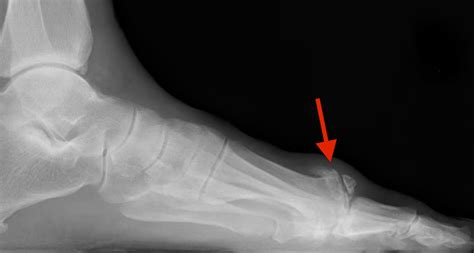 What causes the bump on top of my big toe joint? | Scott Kilberg