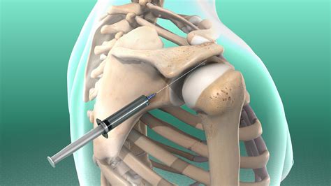 Watch: Subacromial Injection