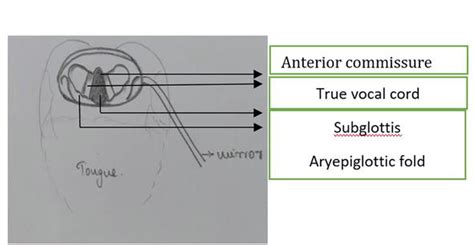 Laryngeal Examination with Laryngeal Mirror and Laryngoscopy | IntechOpen