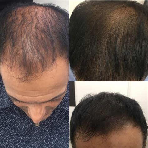 The Effects Of Surgery On Hair Loss | Justinboey