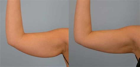 How to Get Rid of Flabby Arms - 4 Effective Exercises