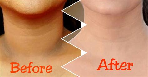 Easy Ways To Remove Dry And Dark Skin Around Your Neck!