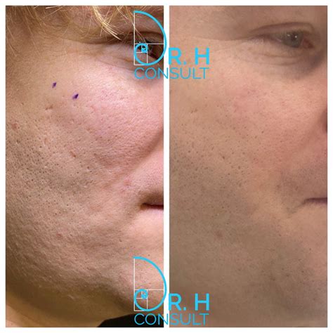 Subcision for Acne Scars London & Surrey UK | Dr H Consult