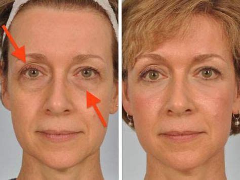 Solve Your Sagging Eyelids Problem Naturally In 2 Minutes | Droopy ...