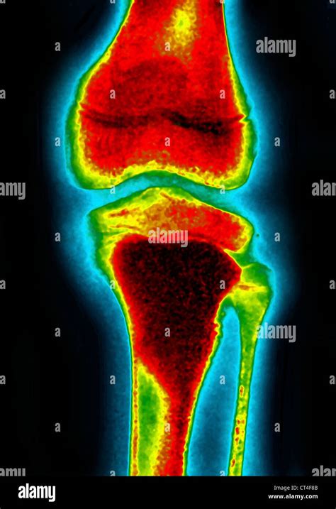 Osteosarcoma knee hi-res stock photography and images - Alamy