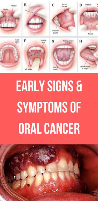 Early Signs & Symptoms of Oral Cancer - wellness magazine