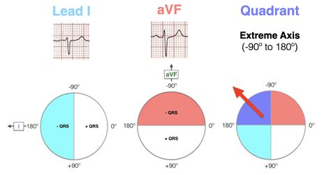 Ecg Axis Lead 1 And Avf Axis Measurement Quadrant Med - vrogue.co