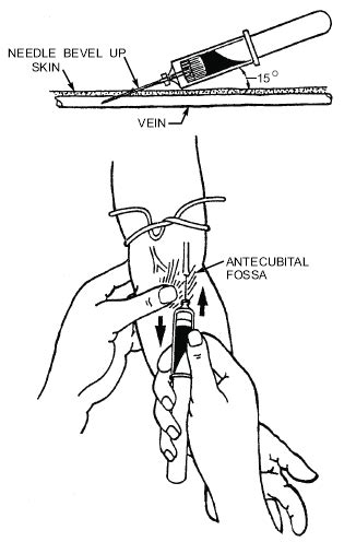 vein puncture in children (41). | Download Scientific Diagram