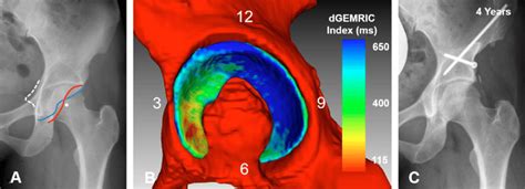 A-C (A) An AP pelvis image shows a 27-year-old woman with severe... | Download Scientific Diagram