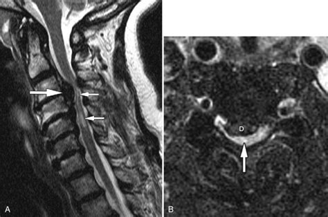 Spinal Stenosis: Cervical | Radiology Key