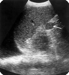 Ultrasound images of Splenomegaly - Radiology Imaging