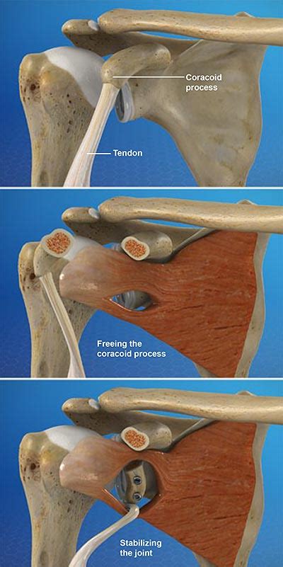 Latarjet Procedure for Shoulder Instability | Central Coast Orthopedic Medical Group