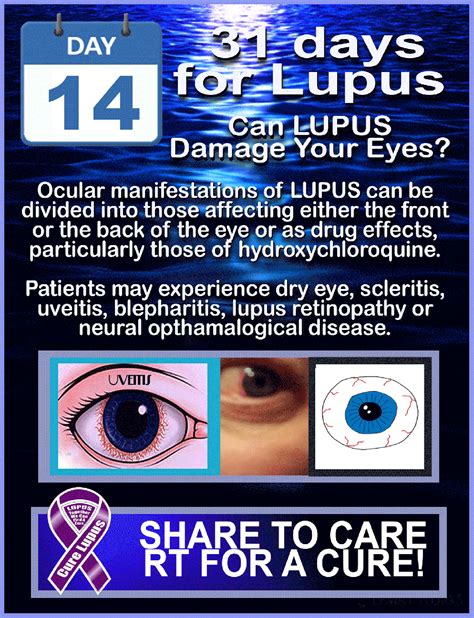 31 Days For Lupus! May is #LUPUSAwarenessMonth!! in 2020 | Lupus, Lupus facts, Rheumatoid ...