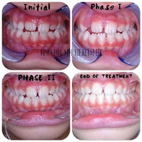 Before and After tongue thrust treatment myofunctional therapy