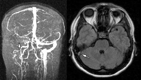 MRI and MRV showing lateral sinus thrombosis in a 31-year-old female... | Download Scientific ...