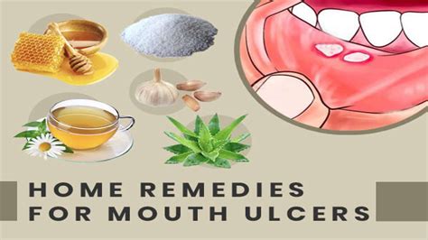 10 Home Remedies That May Help Heal Mouth Ulcers - Boldsky.com