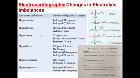 Electrolyte Abnormalities And Ecg Changes Google Search Nurse ...