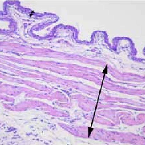 Fluid-filled cavity ( ) and intraepithelial cysts of various sizes (S)... | Download Scientific ...