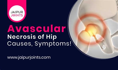 Avascular Necrosis of Hip: Causes, Symptoms!