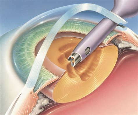 Cataract Surgery - Applecross Eye Clinic