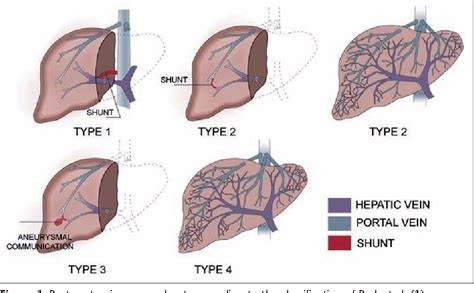 Portal Venous Shunt