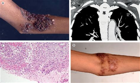 Takayasu arteritis with pyoderma gangrenosum and superficial ...