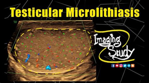 Testicular Microlithiasis || Ultrasound || Case 334 - YouTube