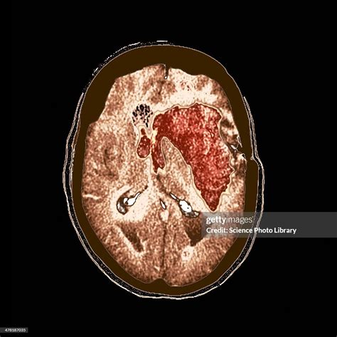 Brain Haemorrhage Mri Scan High-Res Vector Graphic - Getty Images