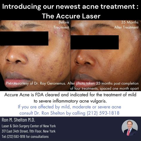 Accure Laser for Acne - Dr. Ronald M Shelton M.D - Medium