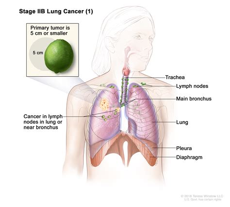 Radiation Levels: Radiation Levels Ct Vs Xray