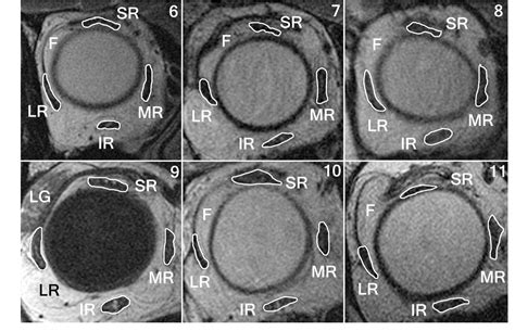 Heavy eye syndrome versus sagging eye syndrome in high myopia - FishmanVision