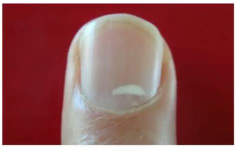 White Spots On Nails Due To Zinc Deficiency - Nail Ftempo