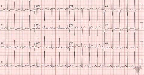 Left Ventricular Hypertrophy | ECG Stampede