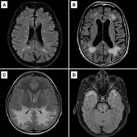 Mri Brain Small Vessel Disease