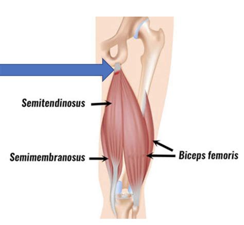 Hamstring Tendonitis: Hamstring Tendinopathy - Dr. Justin Dean