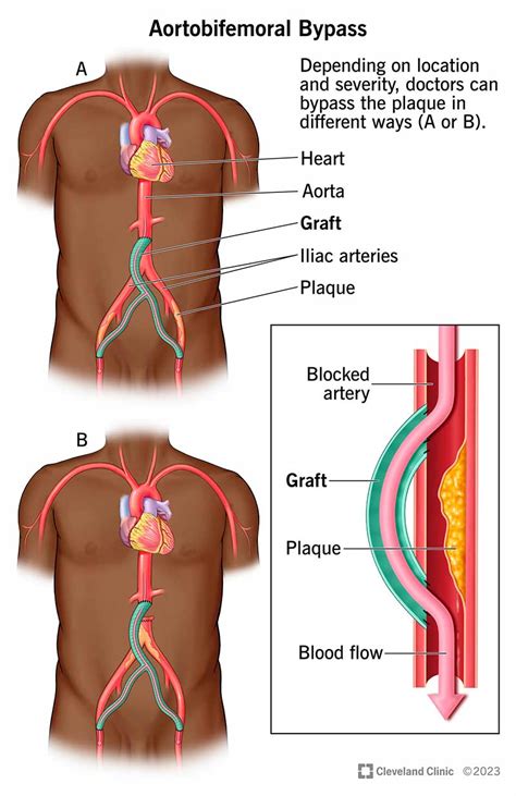 Aortobifemoral Bypass Surgery: What It Is & Procedure Details