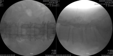 Anatomy of Epidural-Subdural-Subarachnoid space (from outside to inside ...