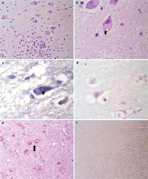 Molecular detection of rabies encephalitis and correlation with ...