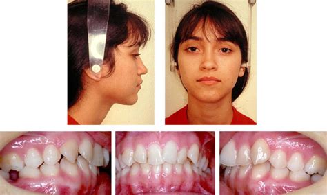 Strategic maxillary second-molar extraction in Class II malocclusion - American Journal of ...