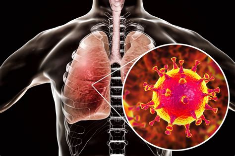 Middle East Respiratory Syndrome (MERS) - Naugatuck Valley Health District