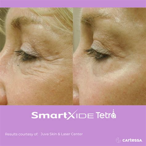 Tetra CO2 Laser Resurfacing In-Office Facial Skincare Treatment