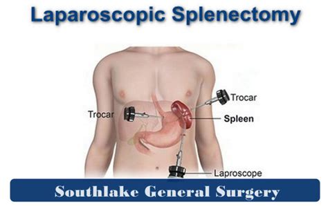 Pre and Post Spleen Surgery Treatment - Southlake General Surgery