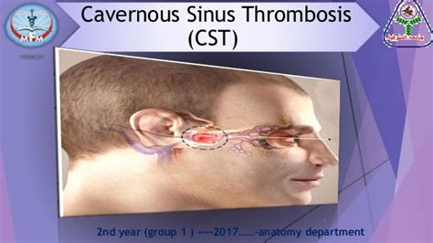 cavernous sinus thrombosis