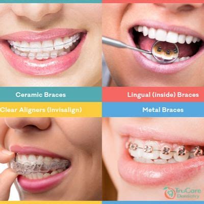 Types of Braces and which one is the best for you? – TruCare Dentistry