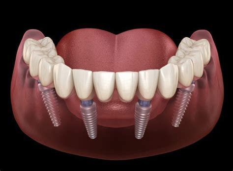 How many teeth are in all on 4? – Fabalabse