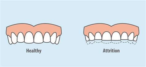 What is Dental Attrition?