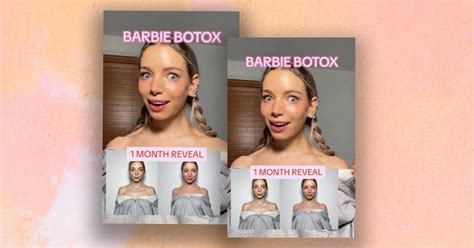 "Barbie botox" : cette tendance pour affiner le cou n'est pas sans danger - Marie Claire