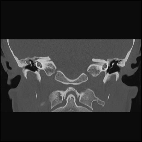 Right attic cholesteatoma | Dr Sean Flanagan